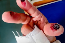 别名“化骨水”！女子散步时踩到氢氟酸后不幸去世