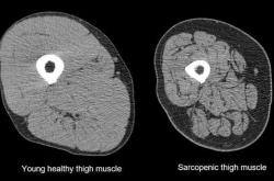 很多老人好好的 为什么摔一跤就走了？这种病死亡率比癌症还高