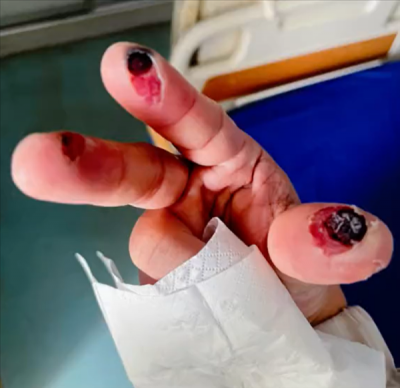 别名“化骨水”！女子散步时踩到氢氟酸后不幸去世