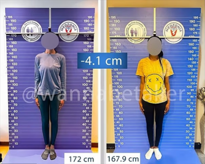 太疯狂！嫌个子太高不好找对象 女子手术切骨变矮