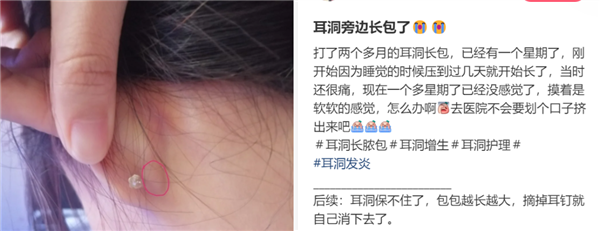 为什么没有人告诉我 打耳洞后会长这种肉疙瘩啊