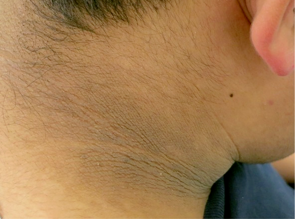 脖子总是黑黑的洗不干净?别大意 这可能是身体在求救