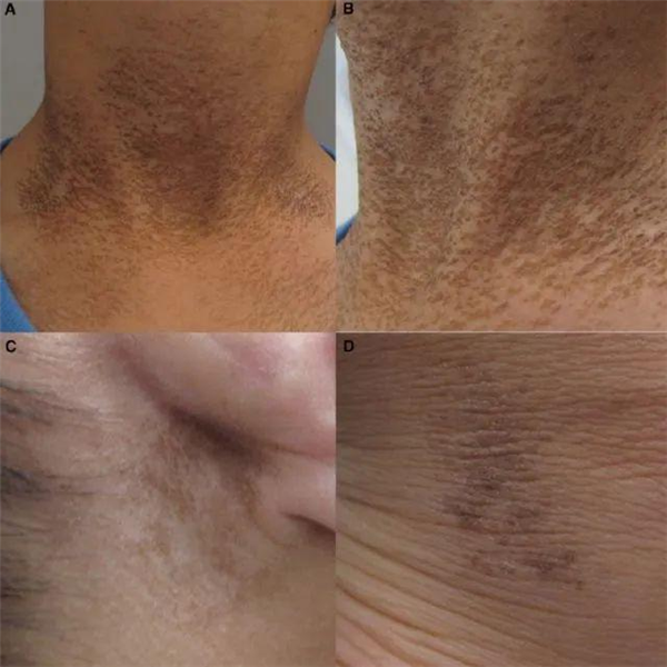 脖子总是黑黑的洗不干净?别大意 这可能是身体在求救